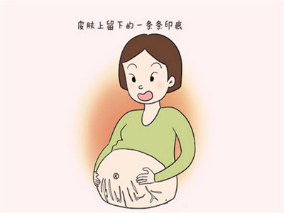 小腹两侧有凸起的妊娠纹该怎么办?